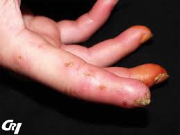 Comment se manifeste la sclérodermie systémique ? | la rhumatologie pour tous