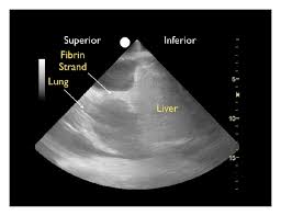 Ultrasound image of a large parapneumonic effusion shows thick septations (arrows) within the rarely, bilateral pleural effusions are present, with one side representing empyema and the other. Ultrasound For The Detection Of Pleural Effusions And Guidance Of The Thoracentesis Procedure