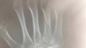 Jika rasa nyeri pada pergelangan tangan terjadi karena patah tulang, maka pengobatan yang dibutuhkan adalah berobat ke dokter ahli tulang alias ortopedi. Tulang Telapak Tangan Kiri Takafumi Akahoshi Patah Di Laga Pamungkas Lawan Barito Putera Tribun Jatim