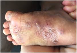 Image result for scabies effects on the human body