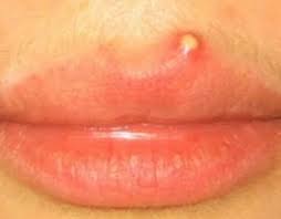 Use benzoyl peroxide to unclog the skin pores and kill bacteria responsible for the pimples and other cystic skin lesion Pimple On Lip Pimples On Lip Line How To Line Lips Pimples