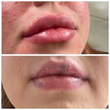 Dissolving Overfilled, Migrated Lips Or Poorly Placed Filler