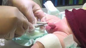 Circumcision doesn't beget circumcision (great article on choosing to leave your second boy in tact when your. Circumcision Videos Infant Boy Circumcisions