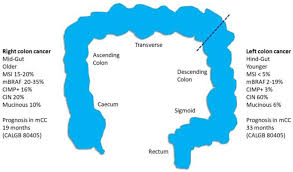 The confusion surrounding semicolon vs. Right Versus Left Sided Colon Cancer Is It Time To Consider These As Different Diseases