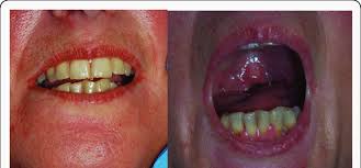 Image result for Trismus