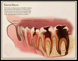 How much to get a cavity filled. What Happens If You Don T Get A Cavity Filled Quora