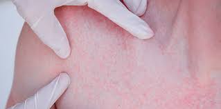 Image result for dermatitis contacta toxica