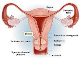 Maybe you would like to learn more about one of these? Kanker Serviks Ciri Ciri Dan Penyebab Kanker Serviks