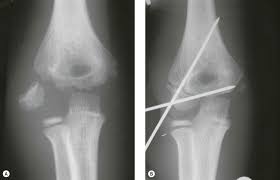 Medial epicondyle fractures represent almost all epicondyle fractures and occur when there is avulsion of the medial epicondyle.they are typically seen in children, and can be challenging to identify. Condylar Fractures In Children Musculoskeletal Key