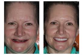 Before & After Photos