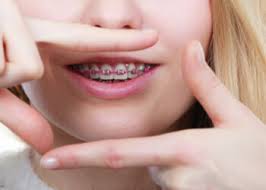 The cost of lingual braces start at approximately $7,500 for a single arch and from $12,500 for a full treatment. Cost Of Braces In Australia Know The Breakdown Analysis