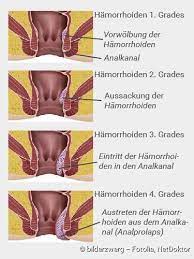 Hämorrhoiden sind erweiterungen der gefässpolster im analkanal, die zu blutungen, schmerzen und entzündungen führen. Hamorrhoiden Behandlung Symptome Vorbeugung Netdoktor
