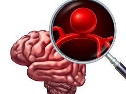Un aneurisma cerebral o aneurisma de una arteria cerebral (del latín aneurysma, dilatación) es una enfermedad cerebrovascular en la cual una debilidad en la pared de una arteria o vena ocasiona una dilatación o abultamiento de un segmento localizado en la pared del vaso sanguíneo. Quanto E Pericoloso L Aneurisma Cerebrale Corriere It
