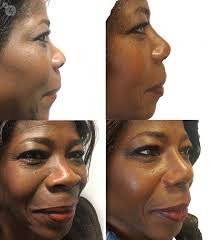 Speak to our team to find out more. Ethnic Rhinoplasty All You Need To Know