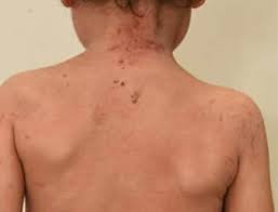 Image result for dermatitis contacta children