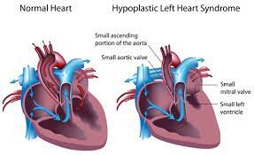Causes And Symptoms Of Hypoplastic Left Heart Syndrome