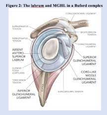 Tearing of the labrum can be found in shoulders of all age groups. The Buford Complex