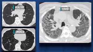 Getty images) fatigue and weakness are normal post covid recovery and the same is likely to continue for some time. Post Covid Lungs Look Worse Than In Those Who Smoked For Decades