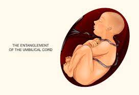 Nuchal Cord Umbilical Cord Around Neck Reasons Symptoms More