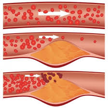 atherosclerosis ile ilgili görsel sonucu