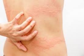 Therefore, the fast way on how to get rid of cramps in feet, legs, hands, and stomach is to rehydrate your body, which will solve the problem quickly. Best Essential Oils For Remedying Hives