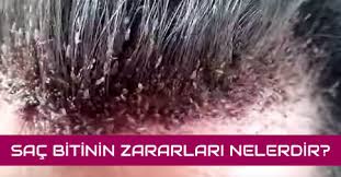 Sac Bitinin Bitlenmenin Zararlari Nelerdir