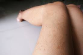 Image result for liver spots on legs