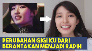 Check spelling or type a new query. Perubahan Gigi Ku Dari Berantakan Menjadi Rapih Tanpa Behel Youtube