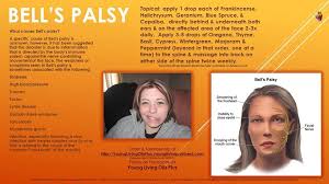 Rarely, bell's palsy can recur. 25 Bells Palsy Ideas Bells Palsy Bell S Palsy Exercises Bells