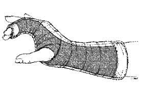 We did not find results for: Radial Gutter Splint Wikem