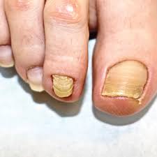 Image result for Beau lines feet