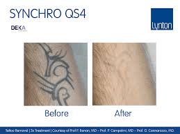 We just didn't send you that email or generate that link.… Synchro Qs4 Powerful Tattoo Removal Laser By Deka Lynton Lasers