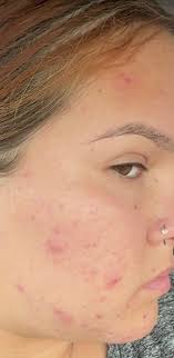 Baking soda helps remove age spots and acne