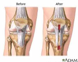 The meniscus is a piece of cartilage made up of two separate disks; Anterior Cruciate Ligament Acl Repair Surgery Abroad Low Cost Acl Repair Surgery In Mexico Costa Rica India