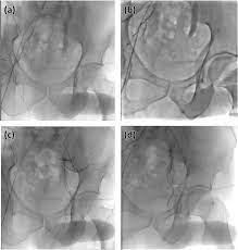 Blending gray hair with highlights and lowlights. Superselective Embolization For High Flow Priapism Refractory To Medical And Surgical Treatments Bmc Urology Full Text