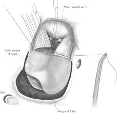 Fabrics woven or knitted from polyester thread or yarn are used extensively in apparel and home furnishings, from shirts and pants to jackets and hats, bed sheets, blankets, upholstered furniture and computer mouse mats. Classic Single Patch Repair Of Atrioventricular Septal Defects Sciencedirect