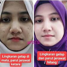 ADA MASALAH #JERAWAT,#JERAGAT,#PARUT,#KULIT KUSAM wajib try produk ni. .  BUKAN JANJI TAPI PASTI! SEMUA TERPAKSA CANTIK AWETMUDA! 💖 UMUR 30,40, 50,  70 TAHUN,PAKAI PUN BOLEH JADI AWET MUDA . ❌payah suntik-suntik