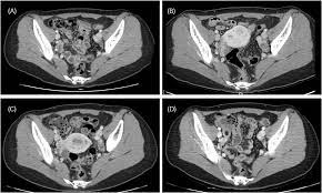 Endometriosis is more common in women who are having fertility issues, but it does not necessarily cause infertility. Ct Scan Of Pelvic Area Presenting No Recurrence Of Endometriosis A Download Scientific Diagram