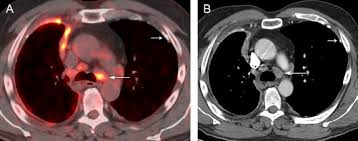 Unilateral pleural effusion and extensive calcified pleural plaques are seen. Imaging Of Malignant Pleural Mesothelioma Pearls And Pitfalls Sciencedirect