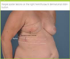 Image result for zoster under breasts