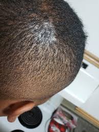 White spots or patches on the skin surface are medically known as hypopigmentation. Itchy Flaking White Spots On Scalp Dermatology Forums Patient