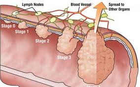 Image result for Vulvar Cancer