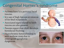Horners Syndrome