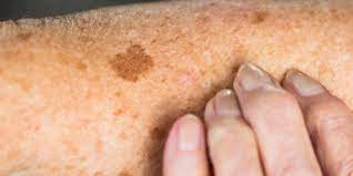 These bumps usually occur on the forehead, nose, cheeks, or chin and can last days. Skin Sunspots Aka Age Spots Causes Prevention And How To Get Rid Of Them