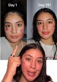 Actine Renov Antes Y Despues