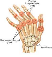 Medical abbreviations and acronyms represent acceptable terms used by physicians and other health care professionals commonly as a reference to rapidly search and accurately record. Rheumatoid Arthritis Ra Definition Of Rheumatoid Arthritis Ra By Medical Dictionary