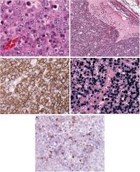 Dr christopher y chew, medical resident, monash health, melbourne, vic, australia; Angioimmunoblastic T Cell Lymphoma Obscured By An Ebv Positive Diffuse Download Scientific Diagram