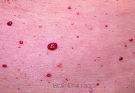 Cherry angioma symptoms cherry angioma vs. Cherry Angiomas Iodine And Detoxing Bromide And Fluoride Cheeseslave
