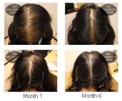 Thus, the use of the complex contributed to the transition of follicles from the resting stage to the growth stage. Hair Loss In Women Female Hair Loss