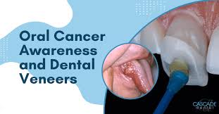 Image result for dental cancer